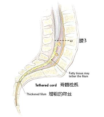 脊髓栓系综合征mr诊断,x线检查能看出颈椎病分型吗