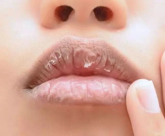 嘴唇一直干裂脱皮使嘴唇变丑,冬季嘴唇开裂最快的解决方法