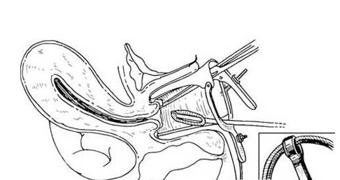 明明避孕了为什么还是会怀孕,为什么带上避孕环还会怀孕呢