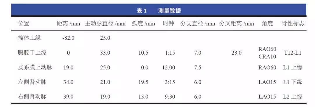 evar手术,胸主动脉夹层开窗手术