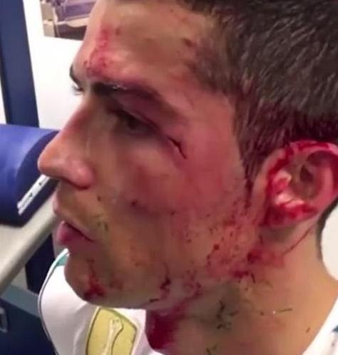 足球场上c罗受伤的暖心瞬间,足球超燃瞬间c罗受伤继续踢