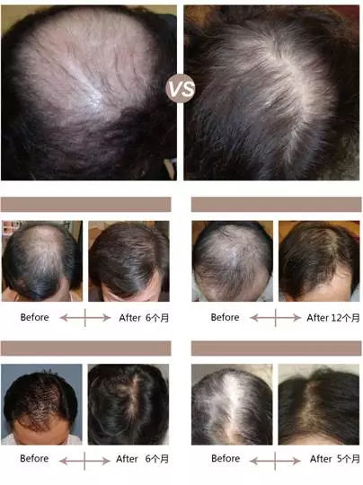 脱发案例丨菩叶毛囊赋活30天,生发效果立竿见影!