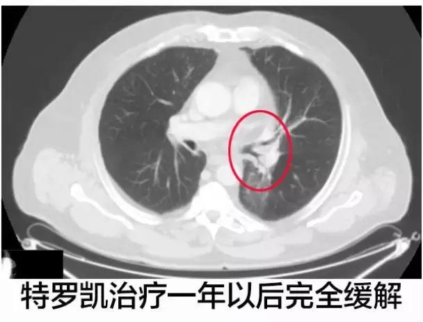 案例：化疗失败的EGFR阴性肺腺癌使用特罗凯病灶完全消失