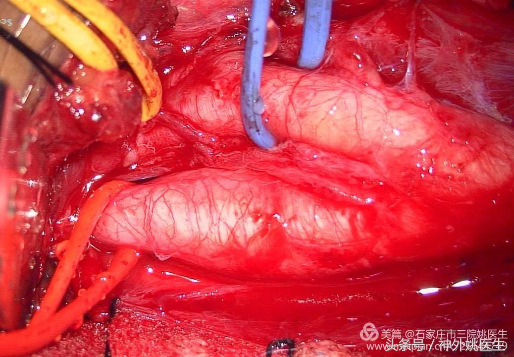 颈内动脉狭窄可以做内膜剥脱术吗,颈内动脉内膜剥脱手术指征