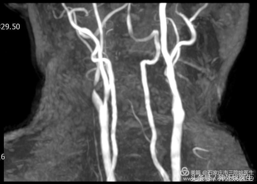 颈内动脉狭窄可以做内膜剥脱术吗,颈内动脉内膜剥脱手术指征