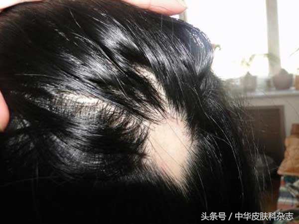 梅毒斑秃脱发,怎么分辨是梅毒性脱发还是斑秃