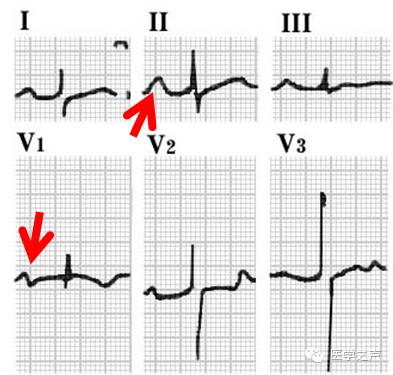 左心房肥大和右心房肥大心电图,心电图左室肥大右室肥大