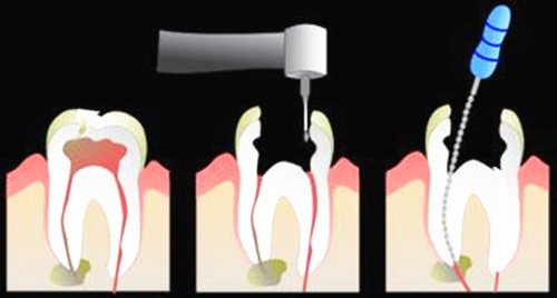 惊！根尖周病竟有这么大危害！中老年人成“重灾人群”！