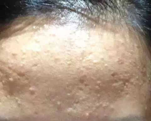 胸口闭合性粉刺最简单的消除方法,额头闭合性粉刺最简单的消除方法