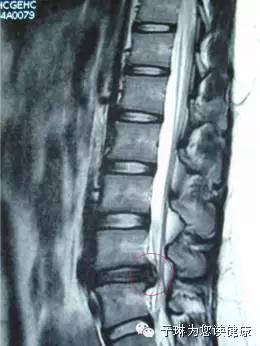 如此严重的腰椎间盘突出症，没开刀，但是治好了