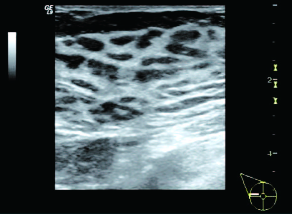 乳腺增生3级结节严重吗,女性乳腺增生怎么治最好