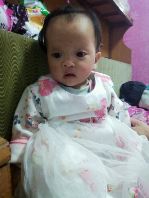 婴儿单纯先天裂唇7毫米,先天性腭裂是什么