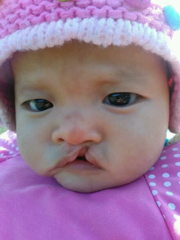 婴儿单纯先天裂唇7毫米,先天性腭裂是什么