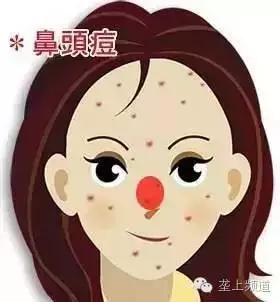 脸上长痘痘可以用醋洗脸吗,用醋洗面会长痘