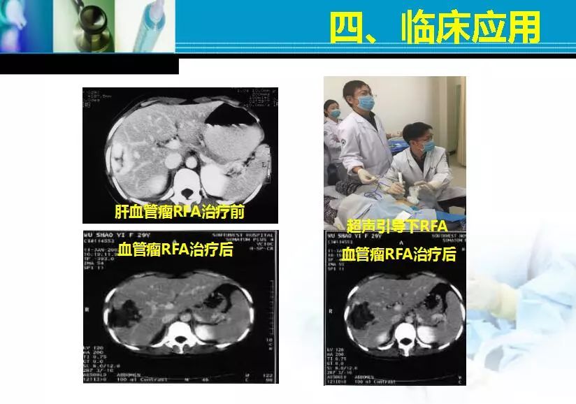 胆管肿瘤射频消融术,肿瘤射频消融厂家
