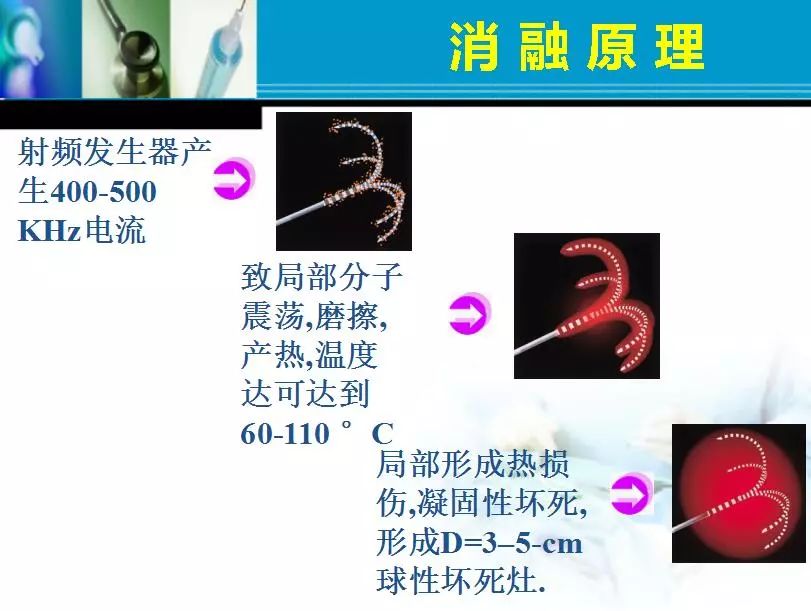 胆管肿瘤射频消融术,肿瘤射频消融厂家