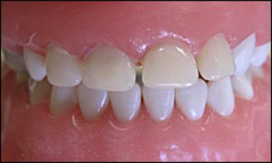 前牙光固化美容修复的方法,乳前牙预成冠修复过程