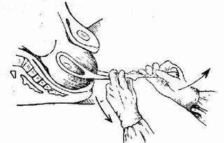 顺产需要产钳夹出来吗,产妇分娩时产钳助产的临床应用