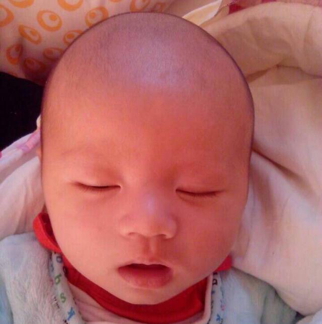 益生菌对黄疸作用,新生儿黄疸益生菌怎么吃