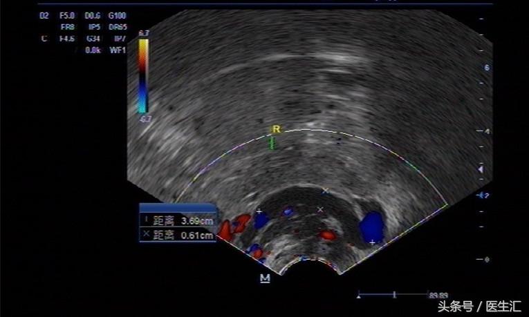 异位妊娠病例讨论教学目的,异位妊娠的病例以及分析