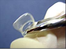 乳前牙预成冠补牙过程,乳前牙龋坏修复