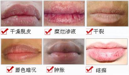 嘴唇一年四季都干裂起皮怎么办,嘴唇一年四季起皮干裂怎么解决好