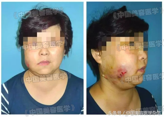 解放军医院治烫伤,解放军医院烧伤特效药