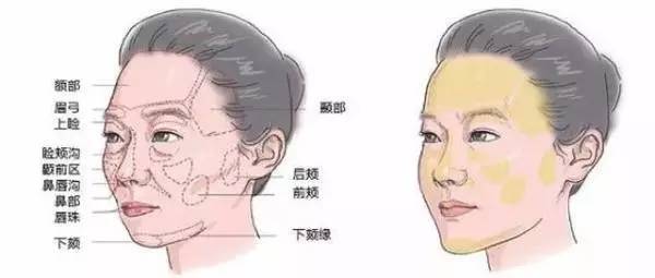 自体脂肪填充川字纹保持多久,自体脂肪填充10天内效果图