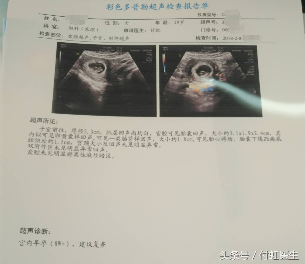 怀孕中期出血先兆流产保胎成功率,早孕出血褐色保胎成功