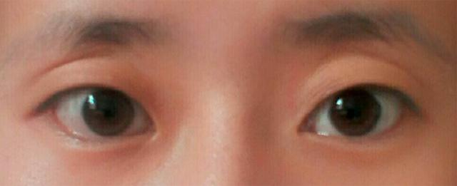 黑眼圈眼纹眼袋是怎么来的,黑眼圈眼袋眼纹问题