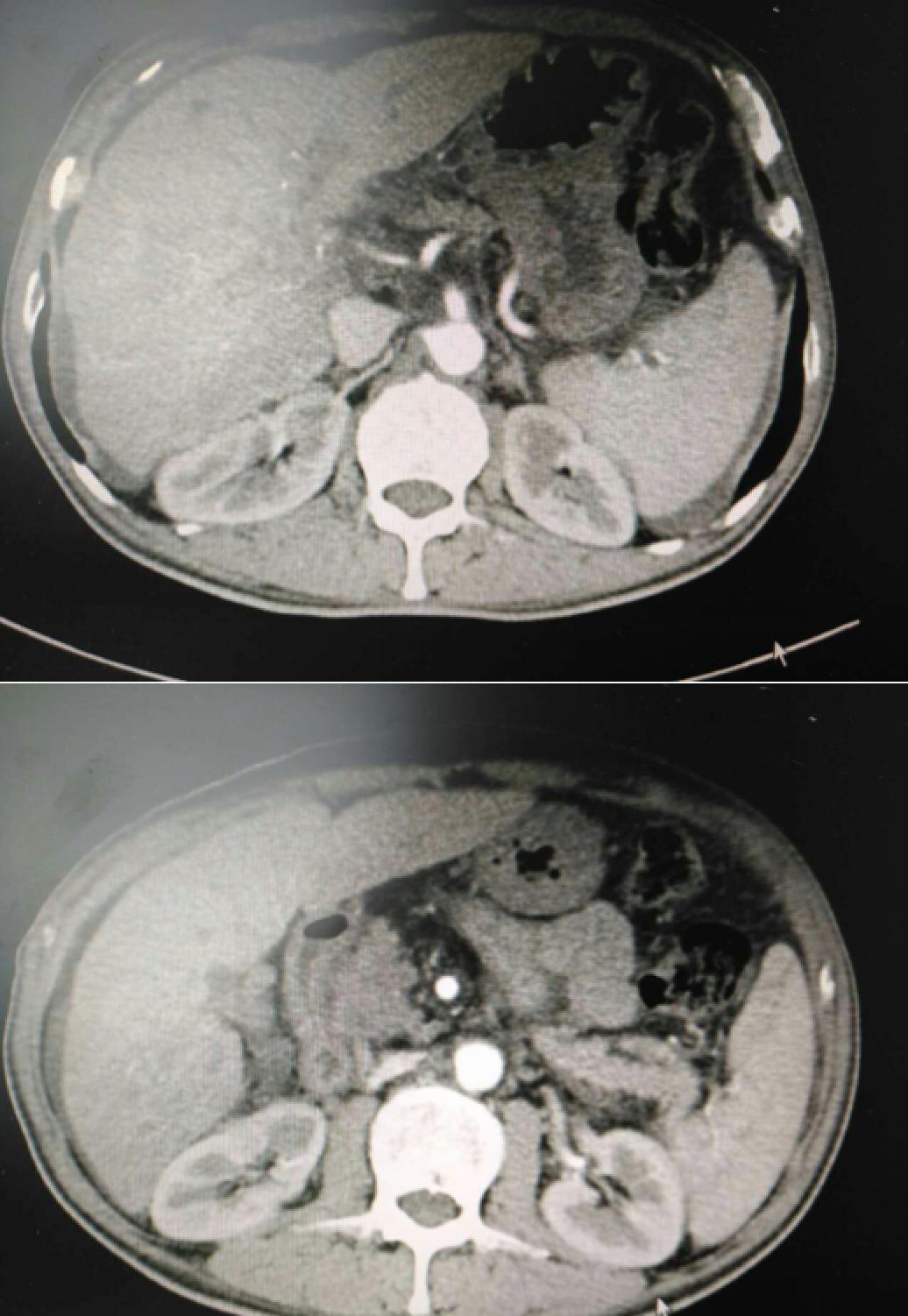 肝癌病例实例100例,肝癌的治疗方法论文