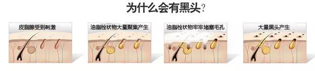 黑头一挤就缩回去,黑头挤了两三次会变大嘛