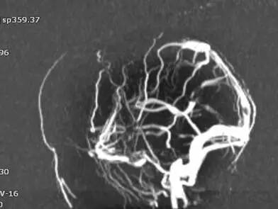 颅内静脉窦血栓ct特征,颅内静脉窦血栓的定性诊断