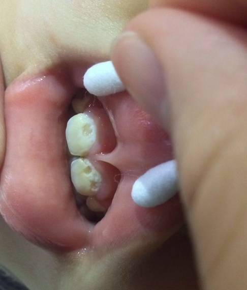 崔玉涛讲自愈,崔玉涛口腔护理方法