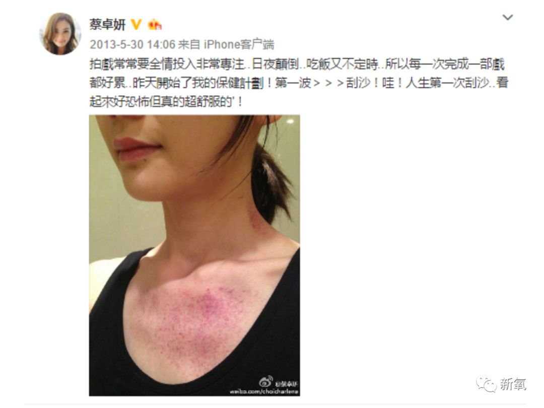 阿娇刮痧后背效果,阿娇被吓哭