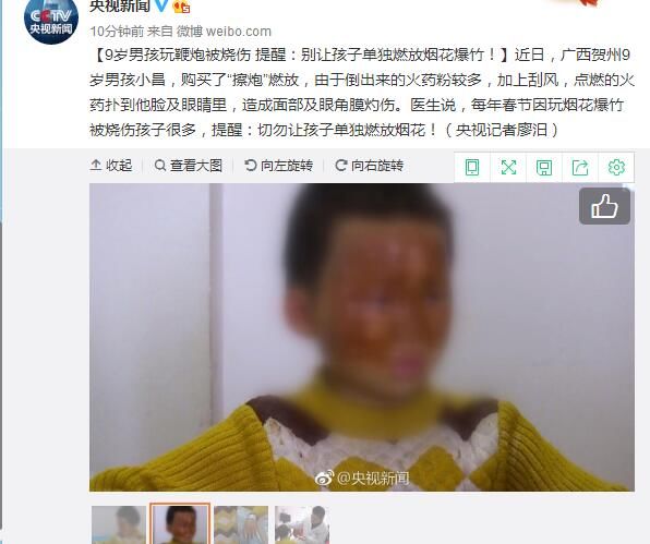 疼！家长们注意：熊孩子这样玩，钢丝刺穿右手中指！