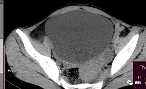 手术纱布遗留在体内可以吸收吗,手术纱布忘了取出会怎样