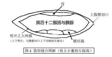 术后腹壁窦道怎样处理,腹部窦道手术怎么判断切除干净