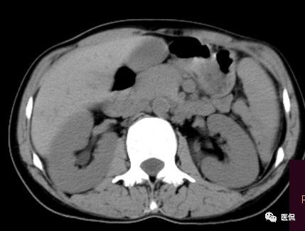 手术纱布遗留在体内可以吸收吗,手术纱布忘了取出会怎样