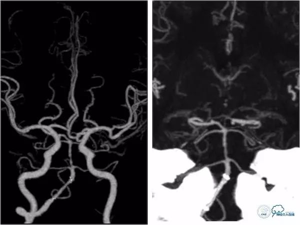 天坛医院做椎动脉狭窄多少要手术,天坛椎动脉狭窄