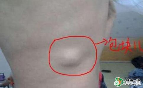 得了脂肪瘤保险豁免,得了脂肪瘤是怎么回事