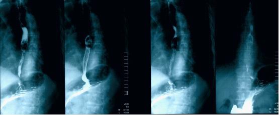 食管鳞状细胞癌病例解析