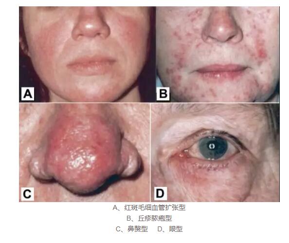 鼻子红红的酒糟鼻怎么护肤,怎么判断自己的鼻子是不是酒糟鼻