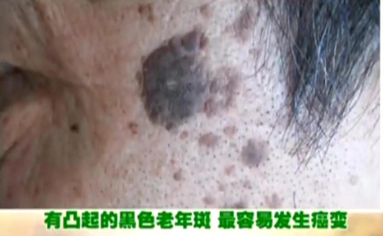 云南白药，黑人等牙膏去老年斑真的靠谱吗？哪种老年斑最危险？