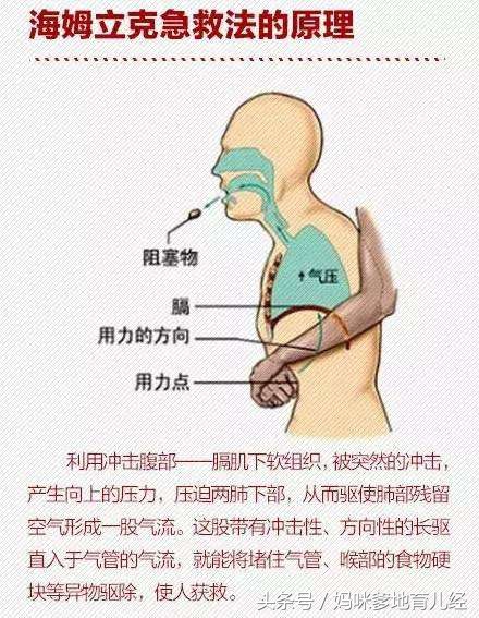 儿童呛到气管急救措施视频,儿童气管呛入异物怎么取出