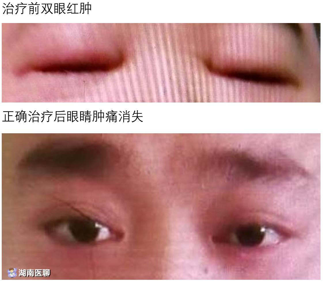 慢性肾病三期中医治疗效果怎么样,肾病七八年了怎么治