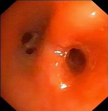 慢性支气管炎会导致咽喉有异物吗,反复咳嗽气管有痰不好怎么办