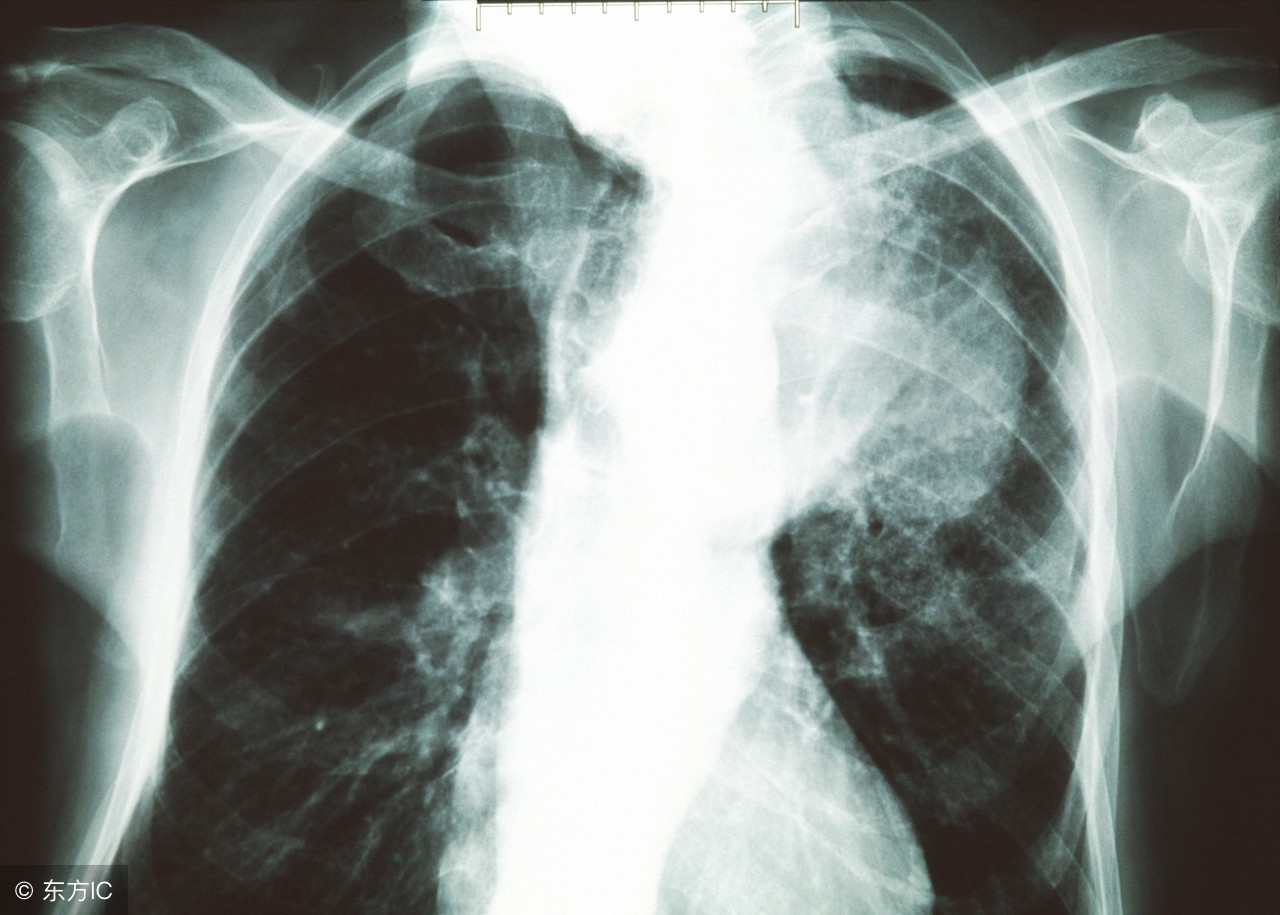 肺癌晚期各种病理的症状,肺癌晚期消化道出血能活多久