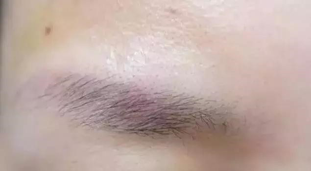 怎么让眉毛快速结痂掉痂,眉毛结痂掉痂修复过程