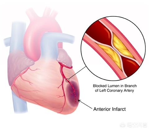 陈旧性心肌梗塞心电图都有q波吗,陈旧性心肌梗死心电图什么表现